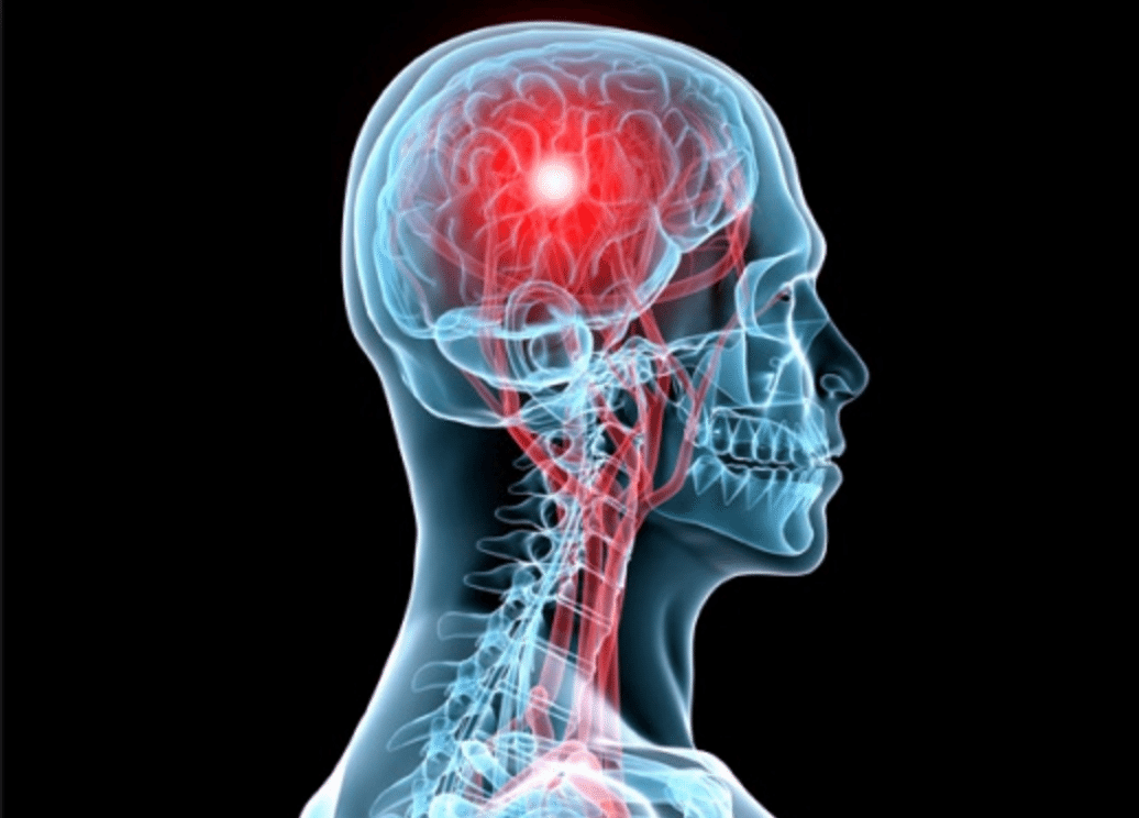 Acidente Vascular Cerebral Avc Causas Sintomas Tratamento Tipos | My ...