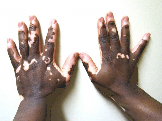 Vitiligo - Causas, Diagnóstico, Tratamentos E Prevenção