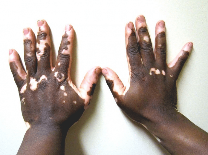 Vitiligo Causas Diagnóstico Tratamentos E Prevenção 6651