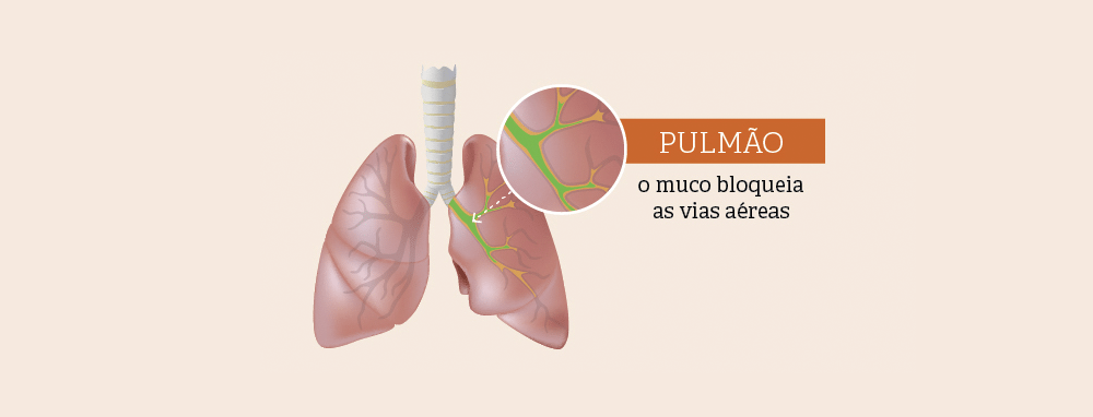 O Que é Fibrose Cística?